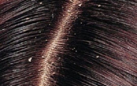 أسباب ظهور قشرة الشعر وطرق علاجها