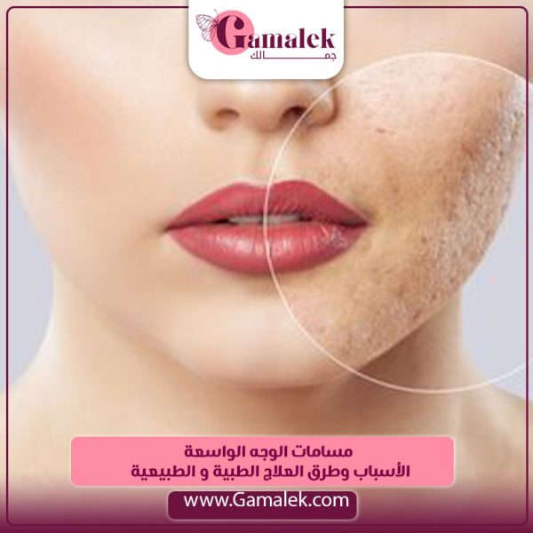 مسامات الوجه الواسعة الاسباب وطرق العلاج الطبية والطبيعية