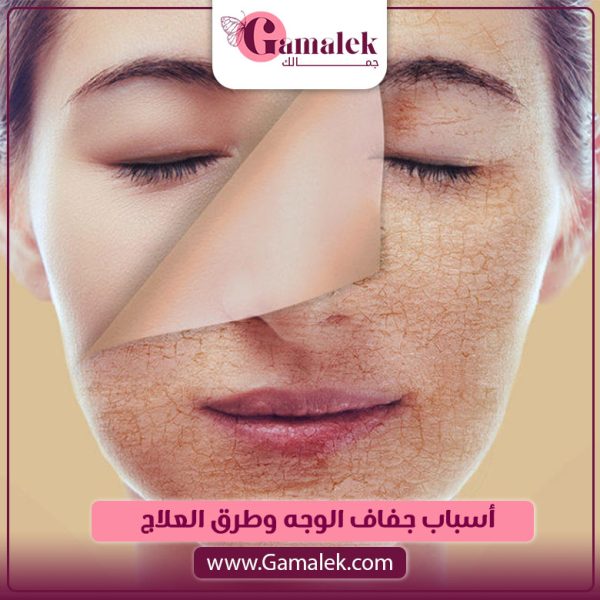أسباب جفاف الوجه وطرق العلاج