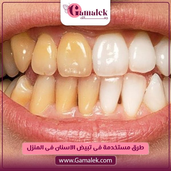 طرق مستخدمة في تبييض الأسنان في المنزل