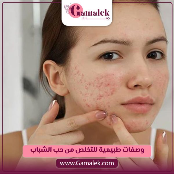 وصفات طبيعية للتخلص من حب الشباب