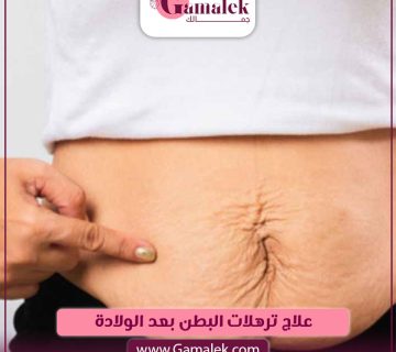علاج ترهلات البطن بعد الولادة