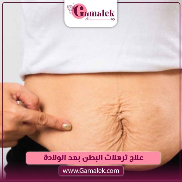علاج ترهلات البطن بعد الولادة