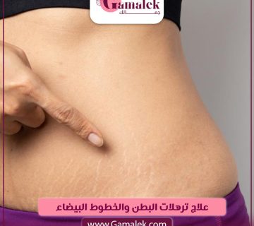 علاج ترهلات البطن والخطوط البيضاء