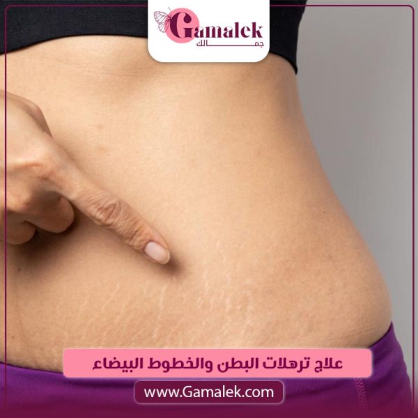 علاج ترهلات البطن والخطوط البيضاء