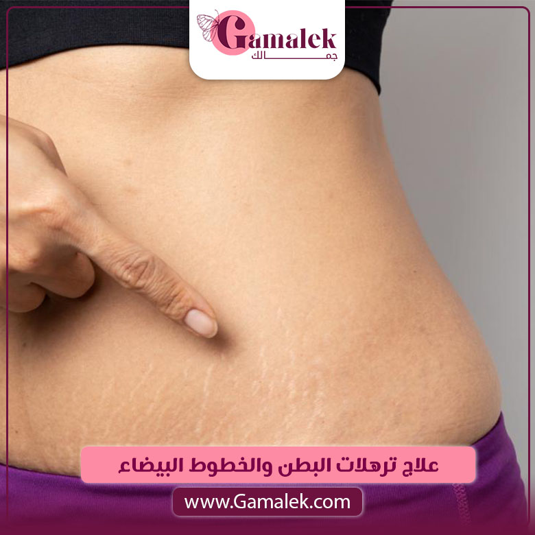 علاج ترهلات البطن والخطوط البيضاء