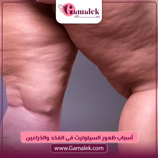 أسباب ظهور السيلوليت في الفخذ والذراعين