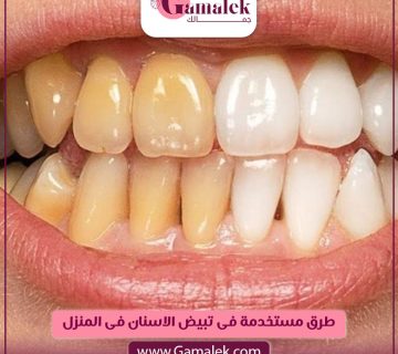 طرق مستخدمة في تبييض الأسنان في المنزل