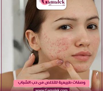 وصفات طبيعية للتخلص من حب الشباب
