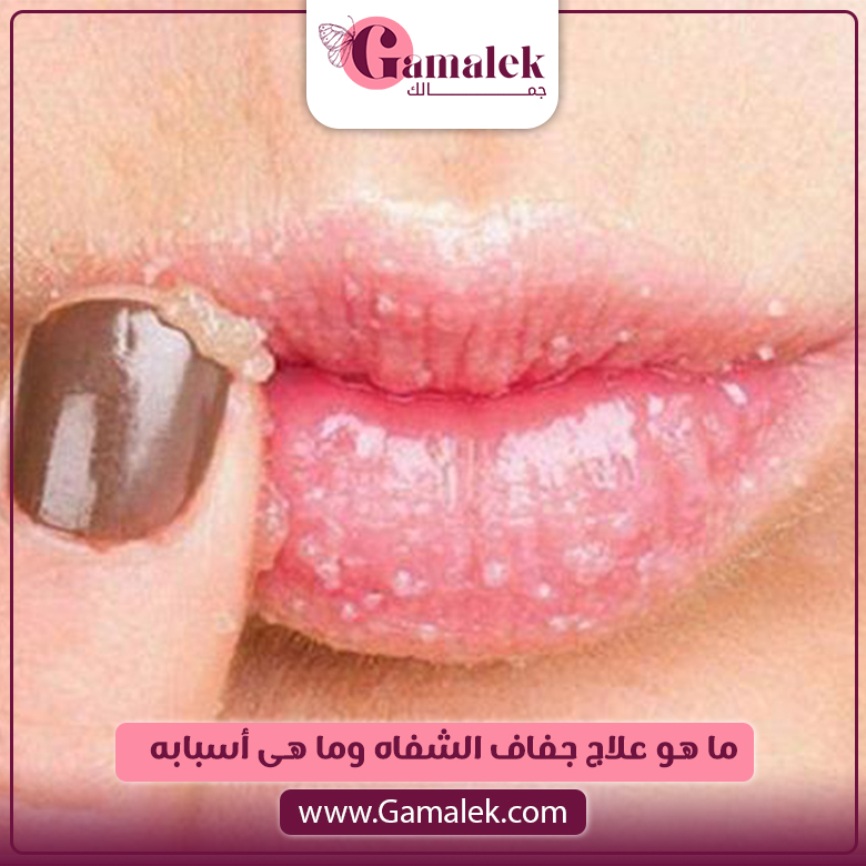 ما هو علاج جفاف الشفاه وما هي أسبابه؟