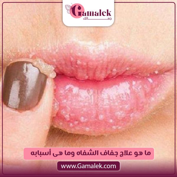 ما هو علاج جفاف الشفاه وما هي أسبابه؟