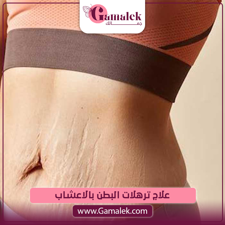 علاج ترهلات البطن بالاعشاب