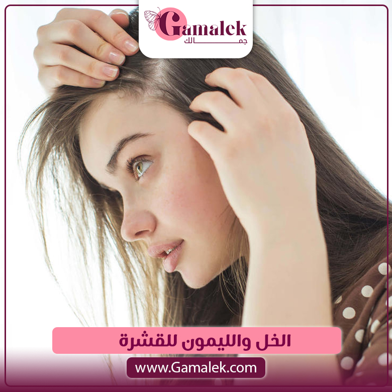 الخل والليمون للقشرة